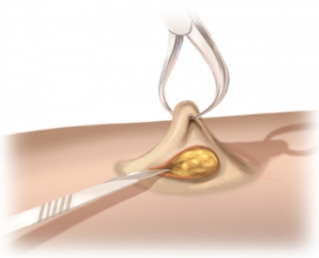 Hautschnitt Stoma und Präparation auf die Faszie