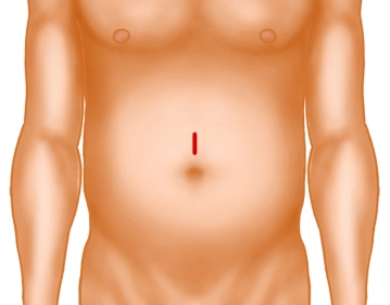 Hautschnitt und Präparation auf die Faszie