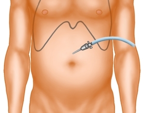 Anlage des Kapnoperitoneums und Einbringen des Optiktrokars sowie der Kamera