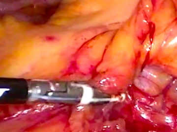 Durchtrennung des Mesenteriums