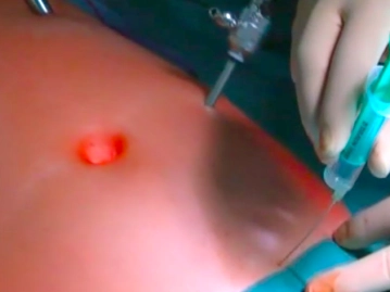 Einbringen der 5 mm-Trokare; Lagerung