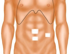 Verschluss der Inzisionen
