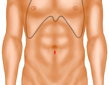 Zugang zum Präperitonealraum