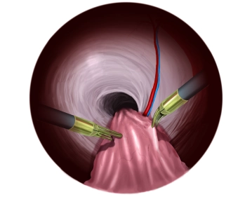 Präparation der rechten Seite bei direktem Bruchsack