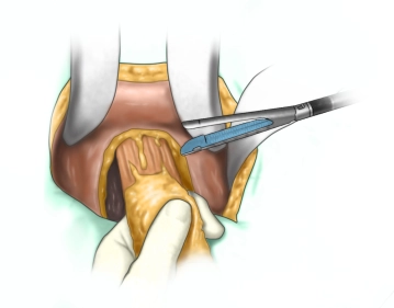 Absetzen des Rektums