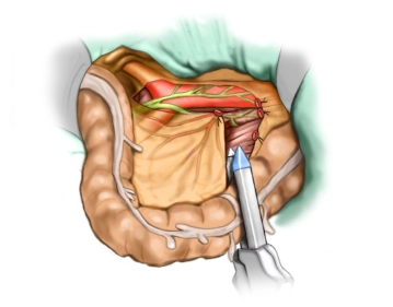 Absetzen des Colon descendens