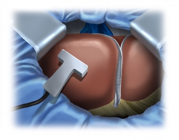 Intraoperative Sonographie