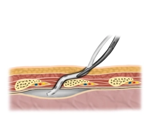 Einführen und Positionieren der Drainage
