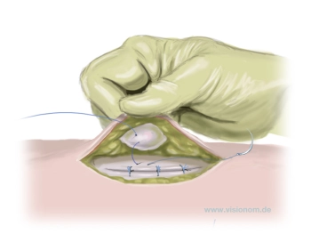 Fixierung des Bauchnabels