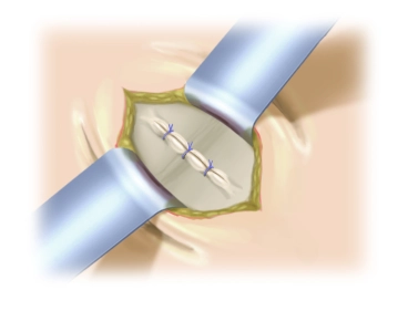 Verschluss der Bruchpforte