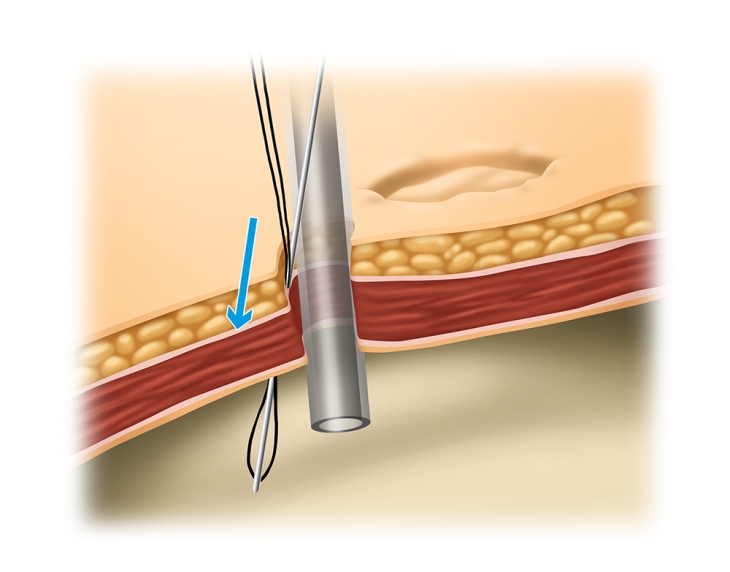 Verschluss von Trokarinzisionen mittels ENDO CLOSE®