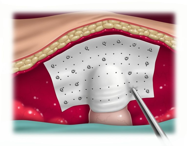 Prävention parastomaler Hernien webop ELearningPlattform Allgemein, Viszeral und