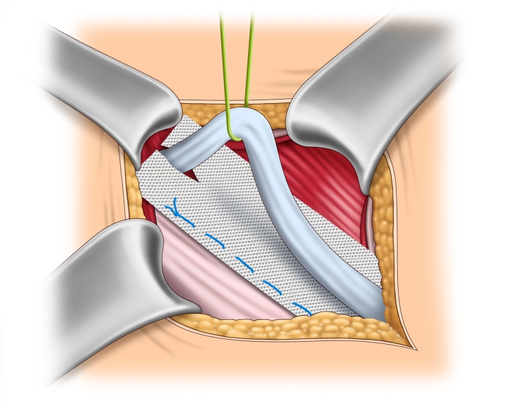 Leistenhernienreparation, Lichtenstein webop ELearningPlattform Allgemein, Viszeral und