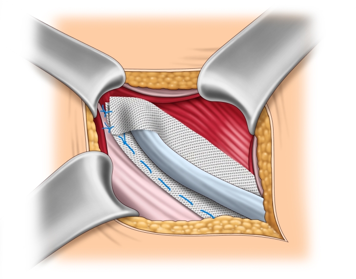 Leistenhernienreparation, Lichtenstein - webop | E-Learning-Plattform Allgemein-, Viszeral- und ...