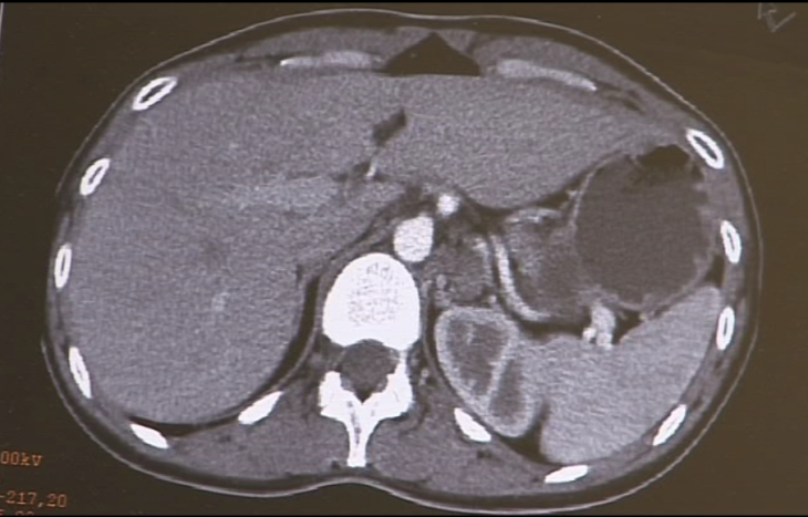 Adrenalektomie links, laparoskopisch