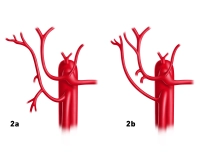 15_LAV_02_a_b_Leberarterie