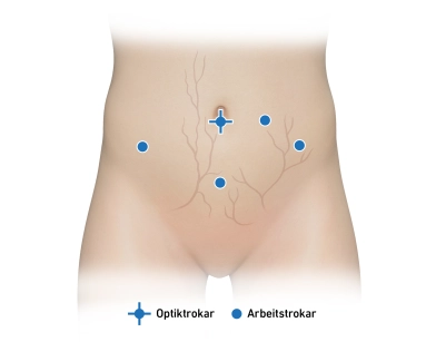 Adnexektomie bds., Spülzytologie, Laparoskopie
