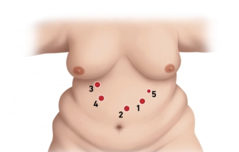 Mini Gastric Bypass / Omega loop-Magenbypass