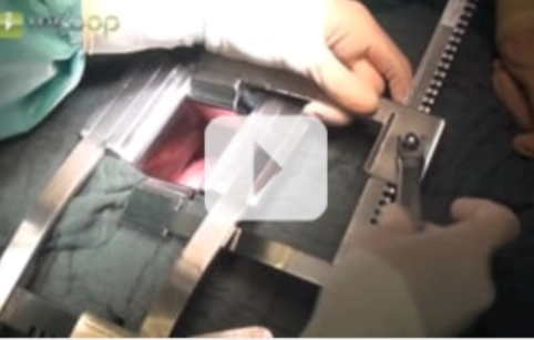 Anterolaterale Thorakotomie