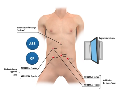 550 Setup und Trokarpositionierung